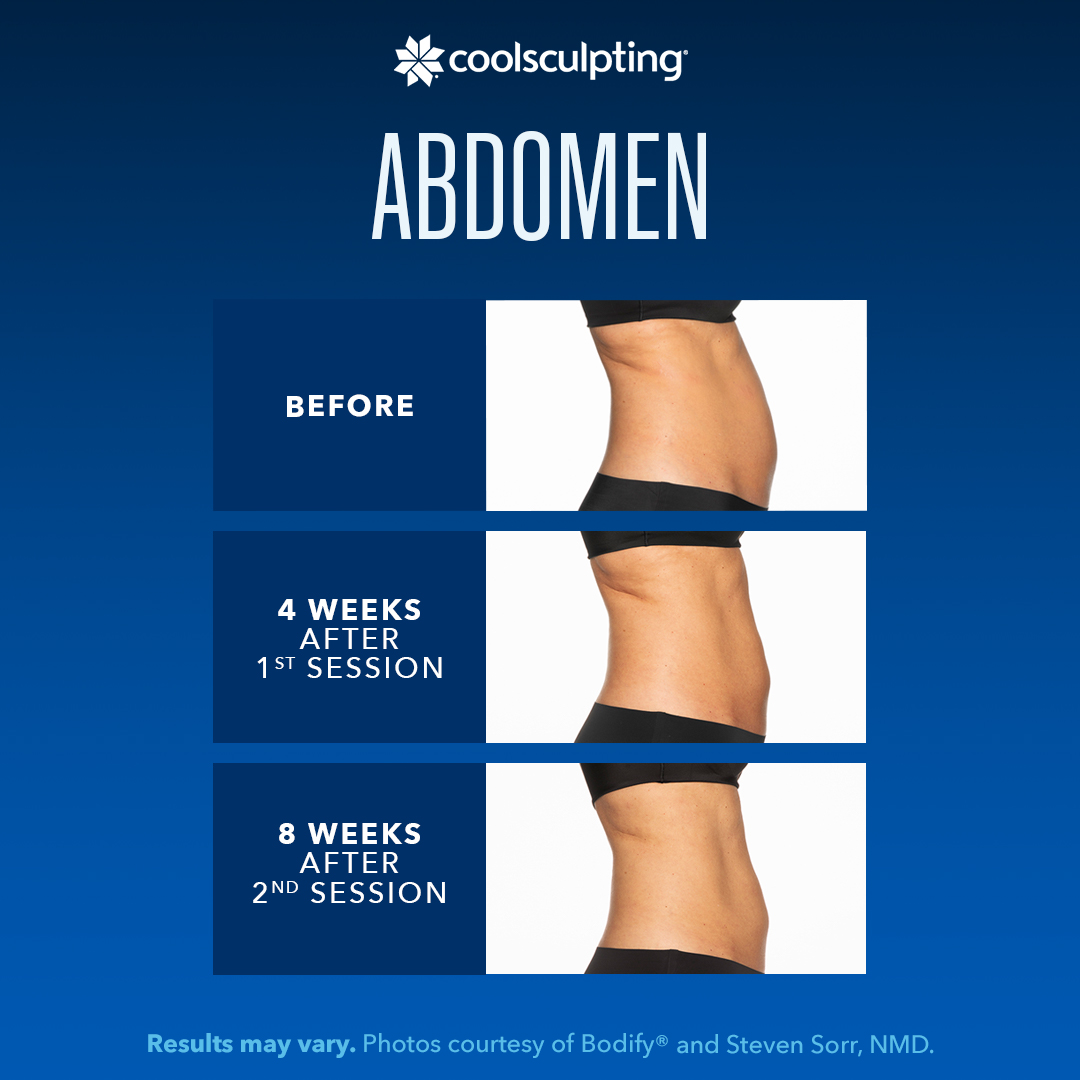 Coolsculpting abdomen